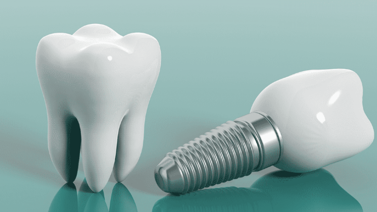 Dental İmplant Yaptırmanın Avantajları Nelerdir?